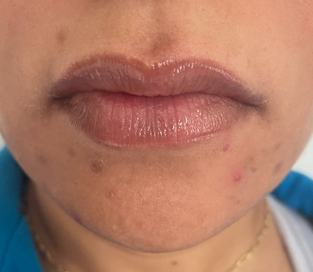Before results of skin using our smooth and renew exfoliation treatment